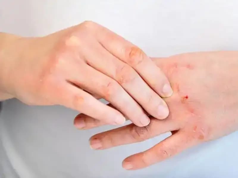 Yetersiz Protein Tüketimi İşaretleri: 6 Belirtiye Dikkat Edin