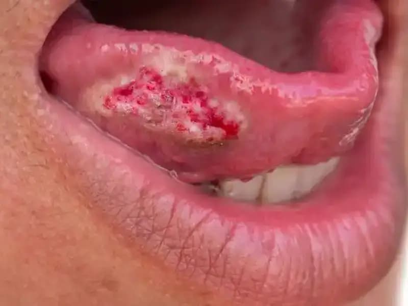 36 Yaşındaki Kadının İhmal Ettiği Belirtiler, Kanser Teşhisine Yol Açtı